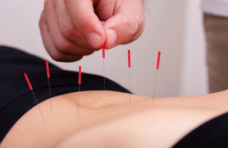 How Dry Needling Helps Improve Muscle Recovery and Mobility?