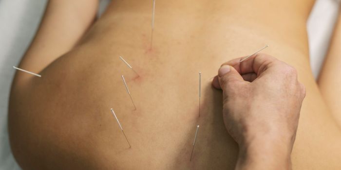 Dry Needling